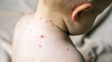 Confirman 85 casos de sarampión en la Provincia y casi 150 mil vacunas vencidas